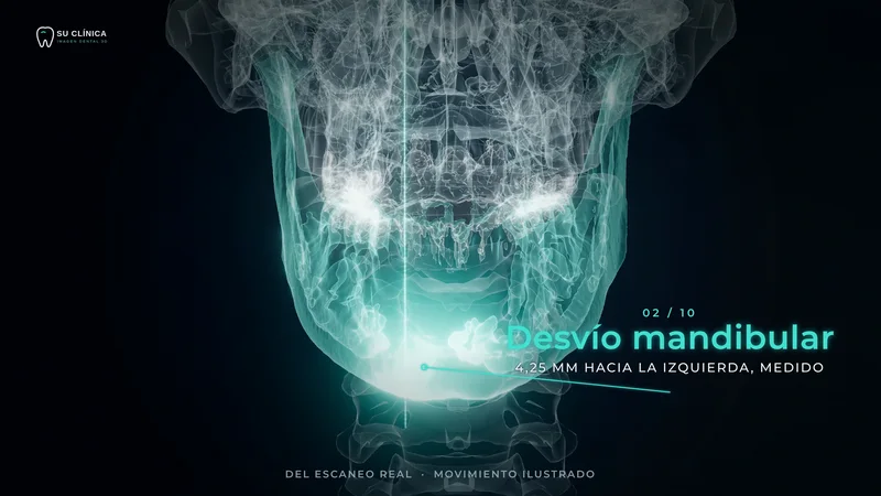 Cráneo 3D estilo rayos X de frente, la mandíbula deslizándose con el desvío del mentón medido