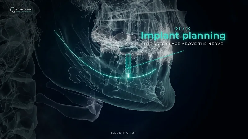 3D lower jaw in x-ray style with a glowing implant planned above the nerve canal